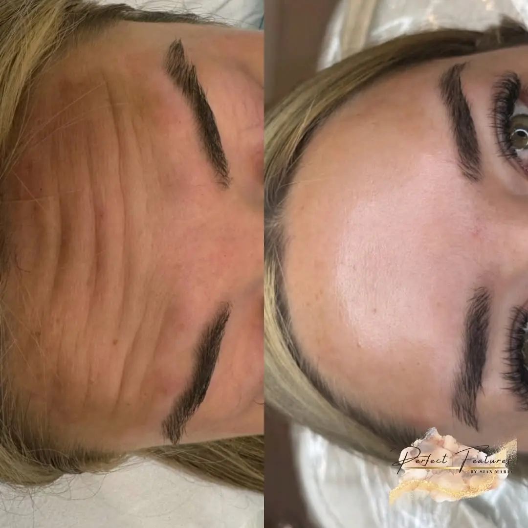 Anti-wrinkle treatment before and after result showing smoother forehead lines and reduced wrinkles at Perfect Features Stalybridge