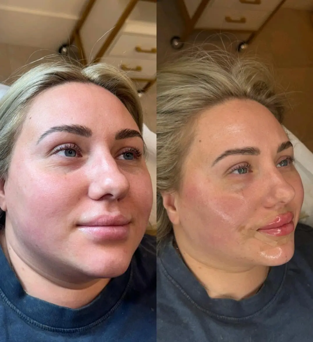 Lip filler before and after result at Perfect Features Aesthetics in Stalybridge