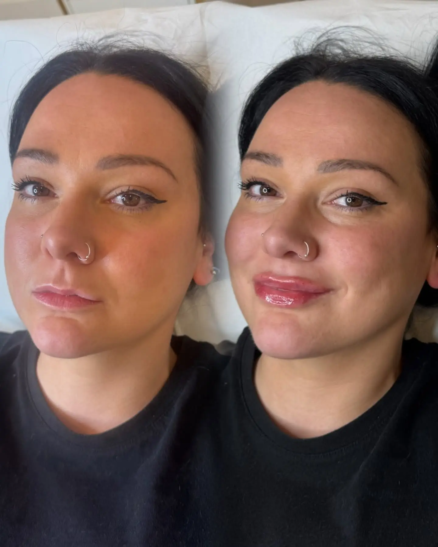M-shaped lip balancing before and after lip filler treatment at Perfect Features