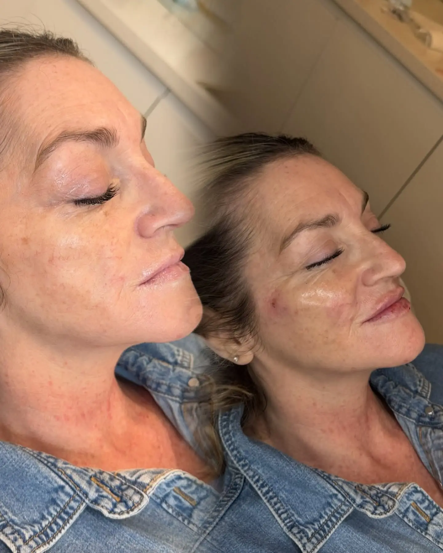 Profile balancing before and after treatment at Perfect Features Stalybridge