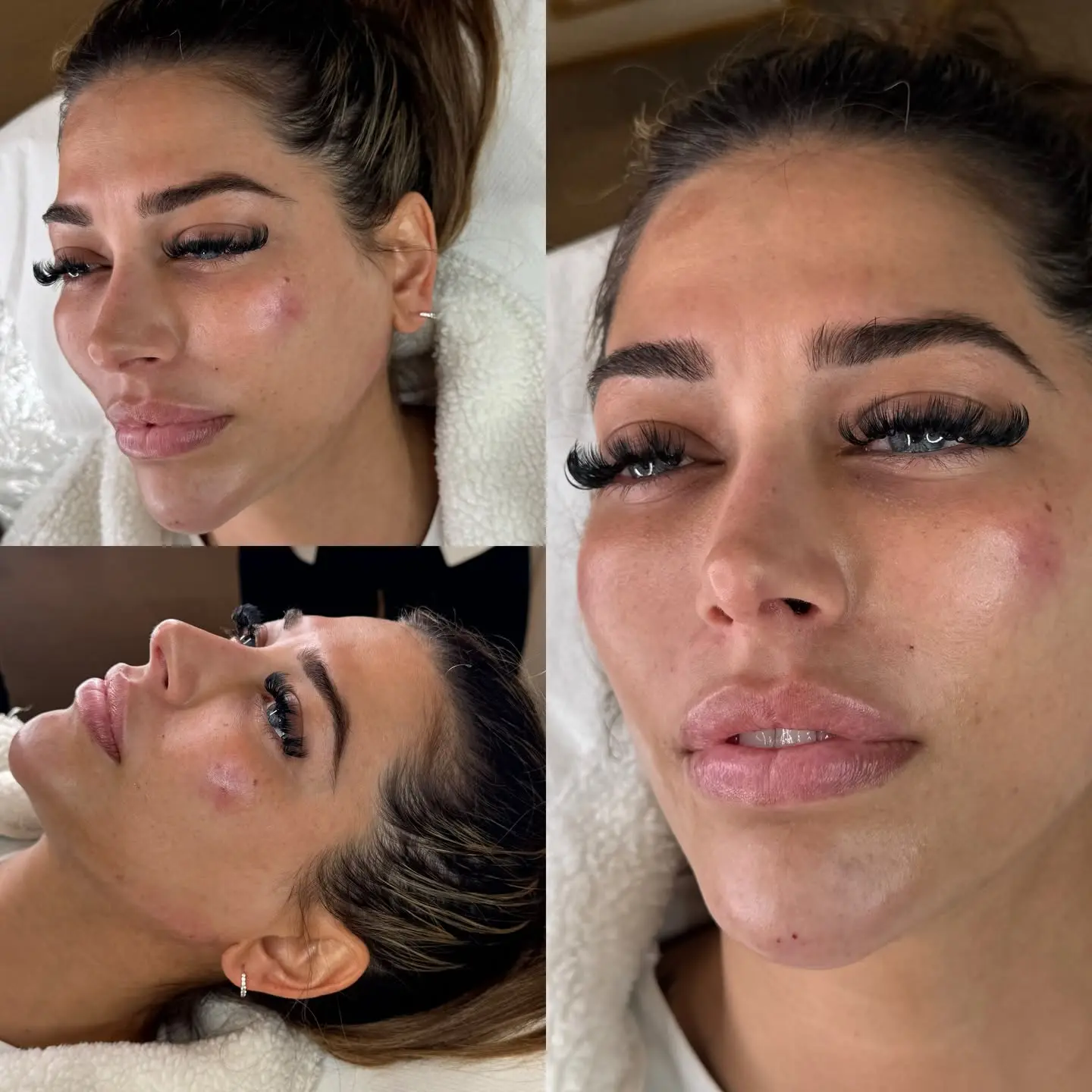 Profile balancing before and after facial balancing treatment at Perfect Features