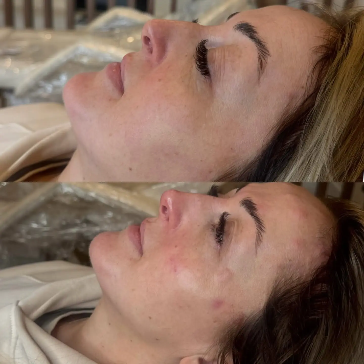 Profile balancing before and after treatment showing improved facial harmony and side profile definition at Perfect Features Stalybridge