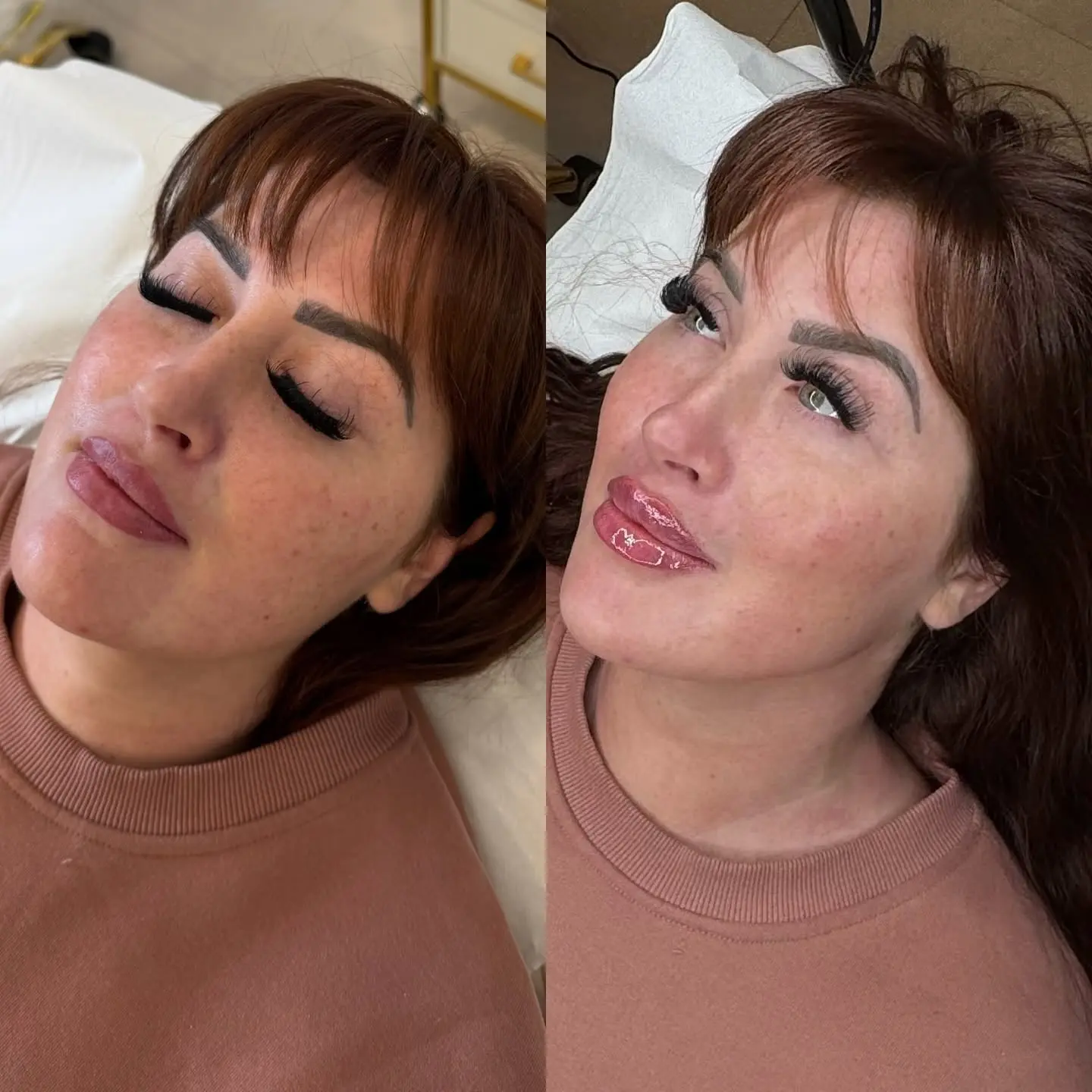 Profile balancing and jawline filler before and after result at Perfect Features
