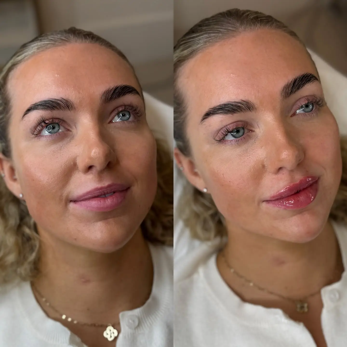 Signature Russian lips before and after treatment at Perfect Features