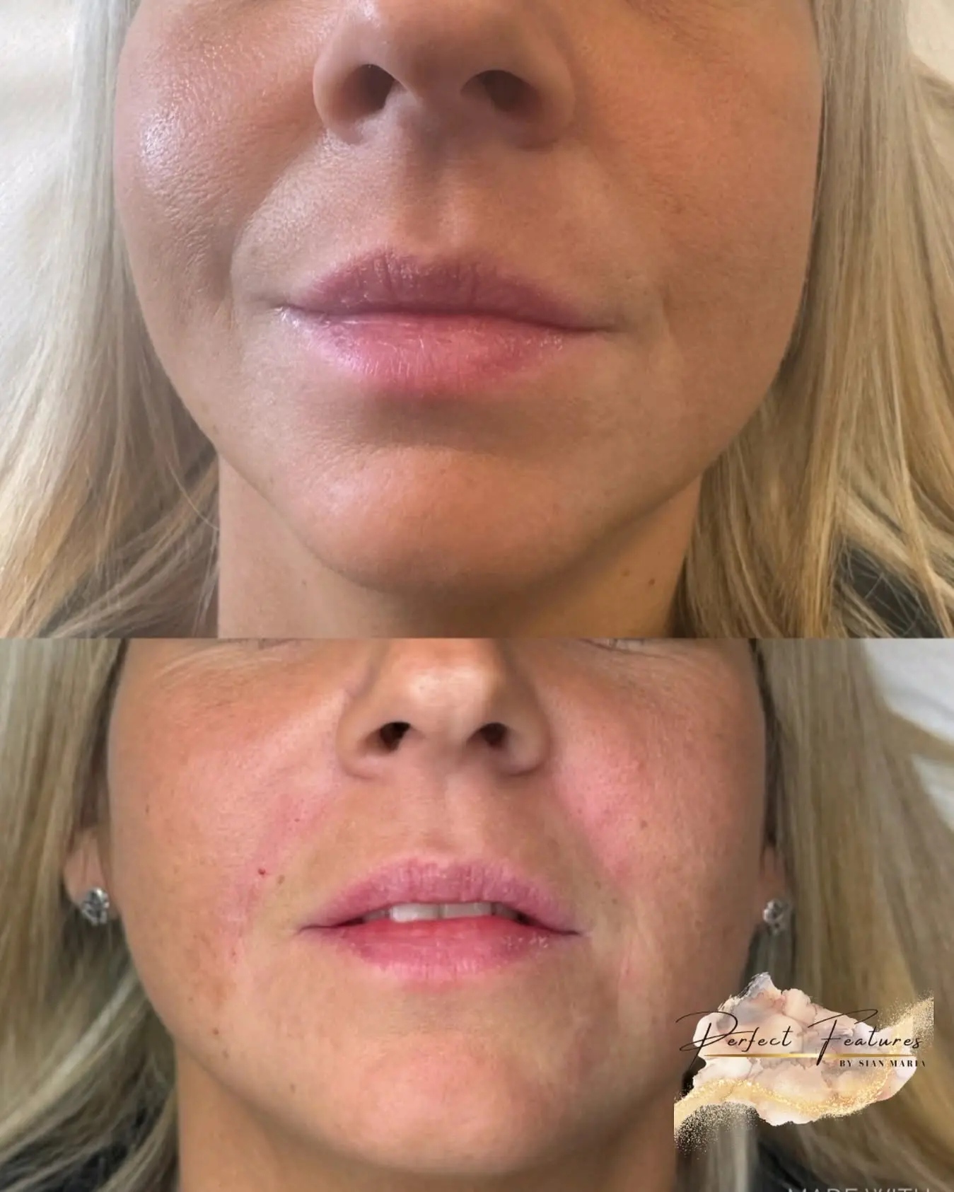 Smile lines before and after dermal filler treatment showing improved facial volume and softer lines around the mouth at Perfect Features Stalybridge